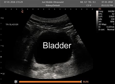 dating scan do i need a full bladder
